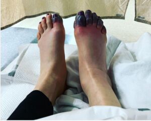 blackened, frostbitten toes